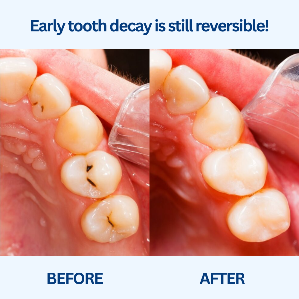 Heightener Gummies + Remineralizing Gum